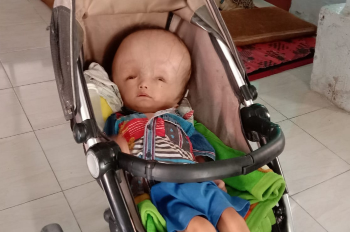 Balita Pengidap Penyakit Hidro Sivalus di Sampang, Butuh Bantuan Kemanusiaan