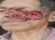 Kardi Warga Blitar Berjuang dari Kanker di Wajah