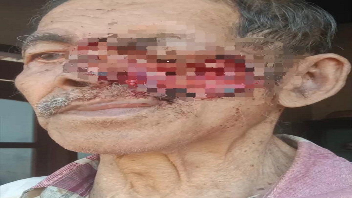 Kardi Warga Blitar Berjuang dari Kanker di Wajah